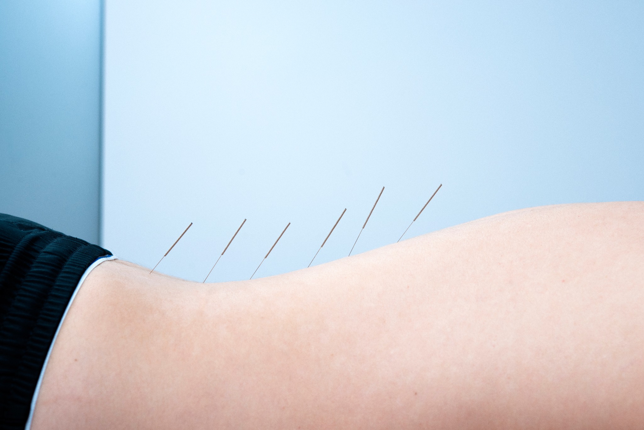 Ciało pacjenta z wbitymi cienkimi igłami do akupunktury w okolicy lędźwiowej, widoczne fragmenty czarnej odzieży i jasnoniebieskie tło.