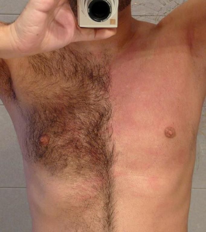 Męska klatka piersiowa, połowa z widocznym owłosieniem, druga połowa po depilacji, widoczny zaczerwieniony naskórek, w dłoni trzymany aparat fotograficzny.