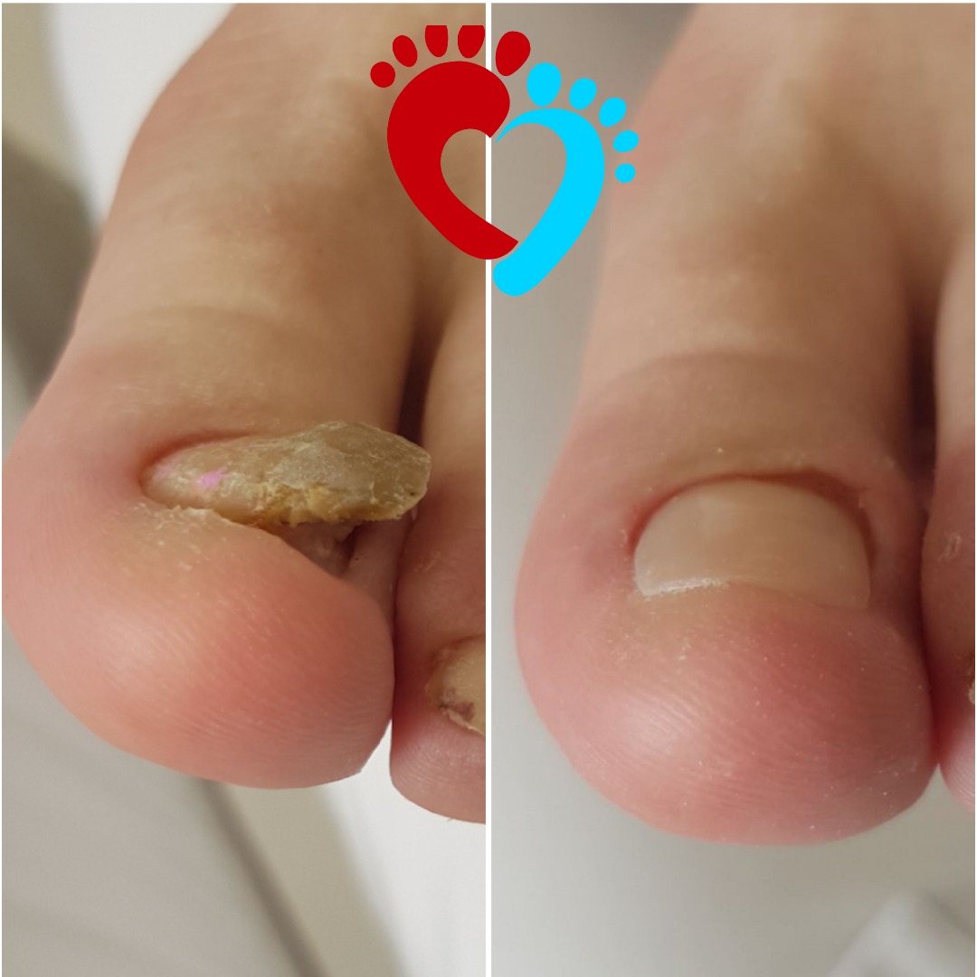 Porównanie paznokcia palucha przed i po zabiegu: zgrubiały, zmieniony chorobowo paznokieć po lewej, zdrowy paznokieć po prawej, z nałożonym symbolem stopy podzielonym na czerwono i niebiesko.