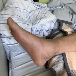 MedyFit Sp z o.o. zabawa ruchem - Zbliżenie na ludzką stopę i kostkę z widocznym zaczerwienieniem i drobnymi zmianami skórnymi, leżącą na łóżku z pasiastą pościelą i wzorzystym kocem.