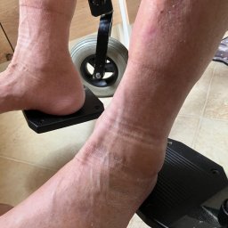 MedyFit Sp z o.o. zabawa ruchem - Opuchnięte, suche nogi z widocznymi zmianami skórnymi, spoczywające na czarnych podnóżkach mobilnego sprzętu, z fragmentem koła w tle i beżowymi płytkami na podłodze.