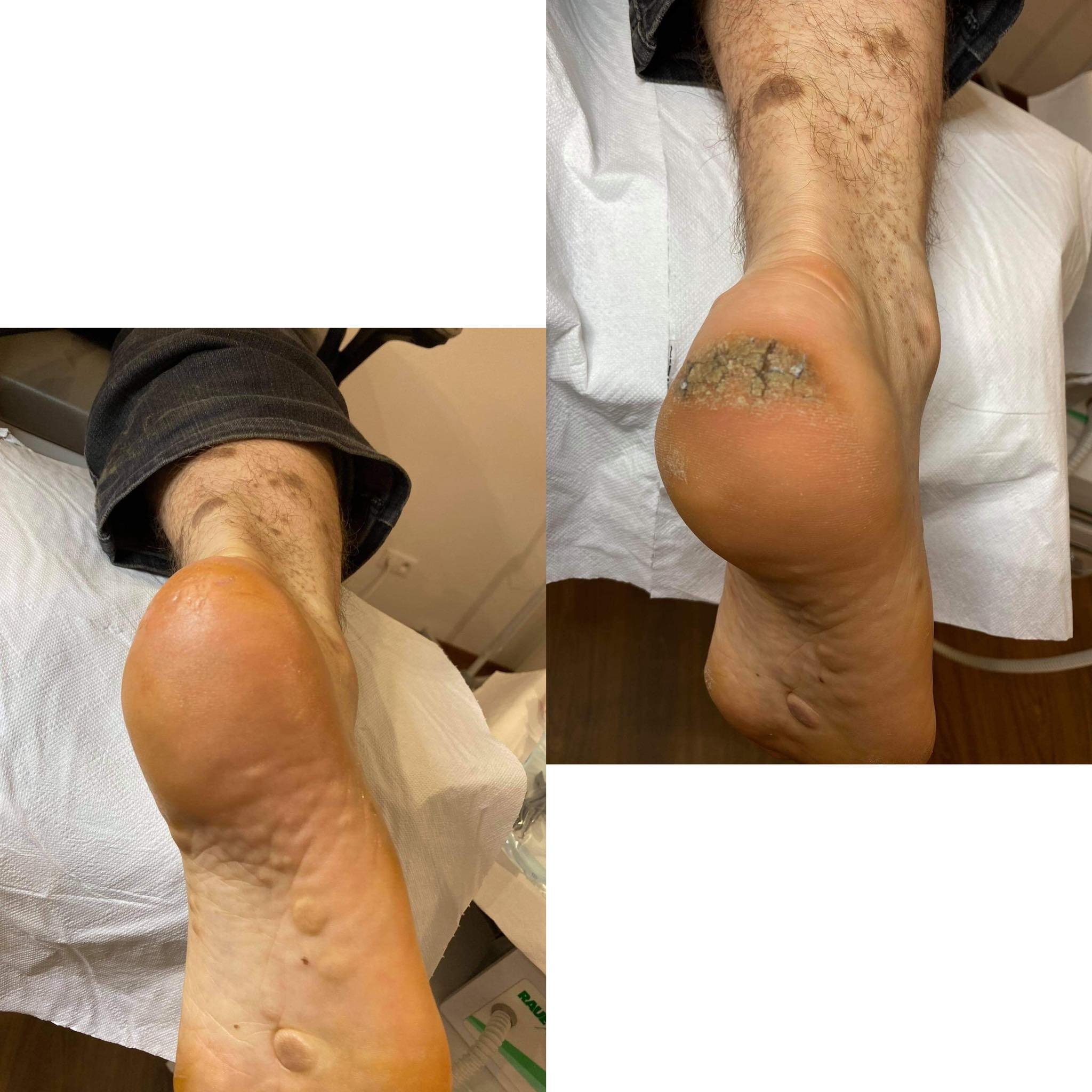 Popękane pięty, zabieg podologiczny