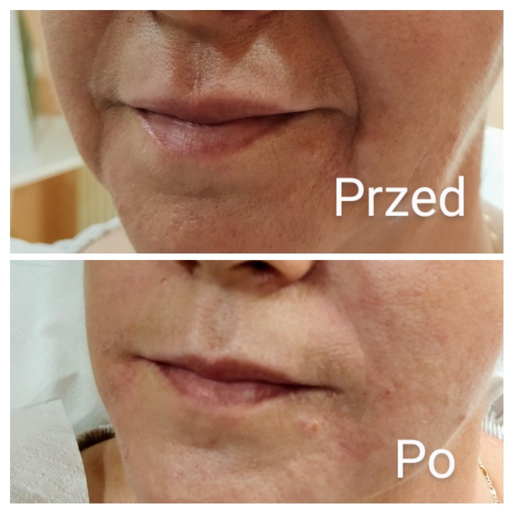 Porównanie skóry wokół ust przed i po zabiegu, widoczne zmniejszenie zmarszczek i poprawa nawilżenia.