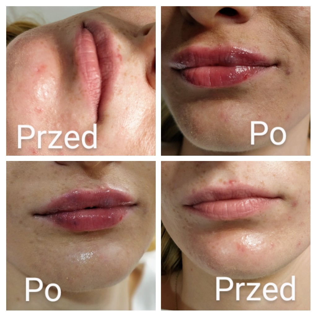 Kolaż przedstawiający usta przed i po zabiegu powiększania, uwydatniający różnicę w objętości i nawilżeniu.