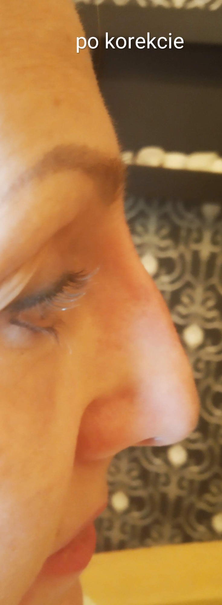 Korekta nosa kwasem hialuronowym