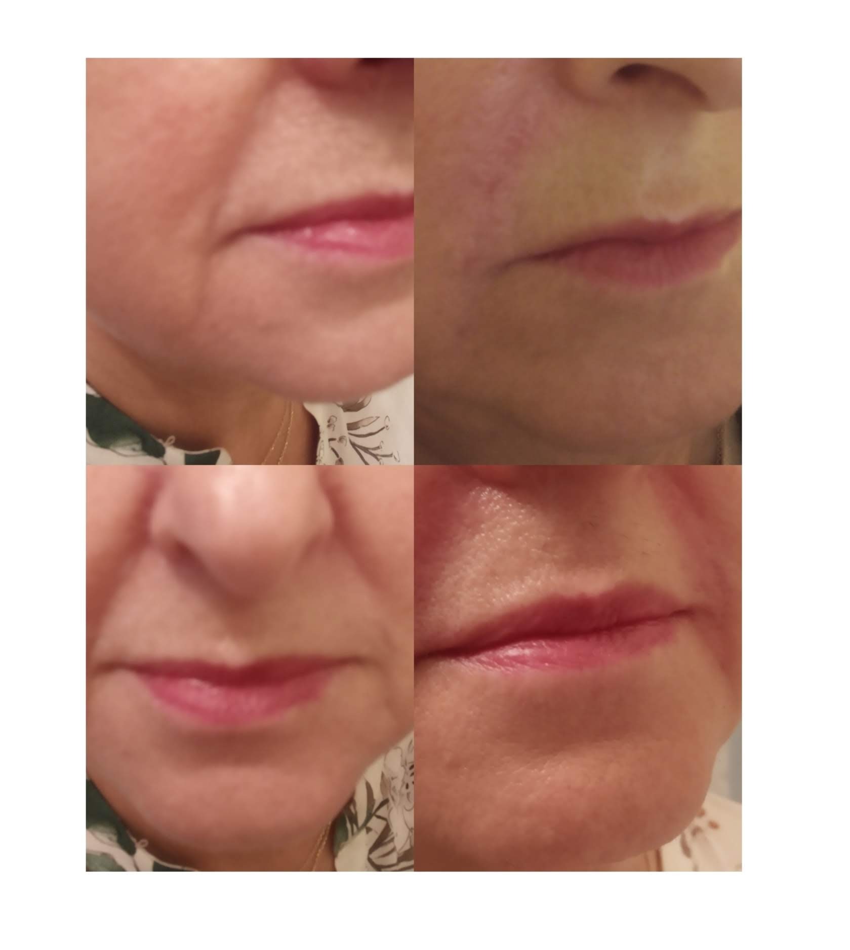 Wypełnienie bruzdy nosowa wargowej