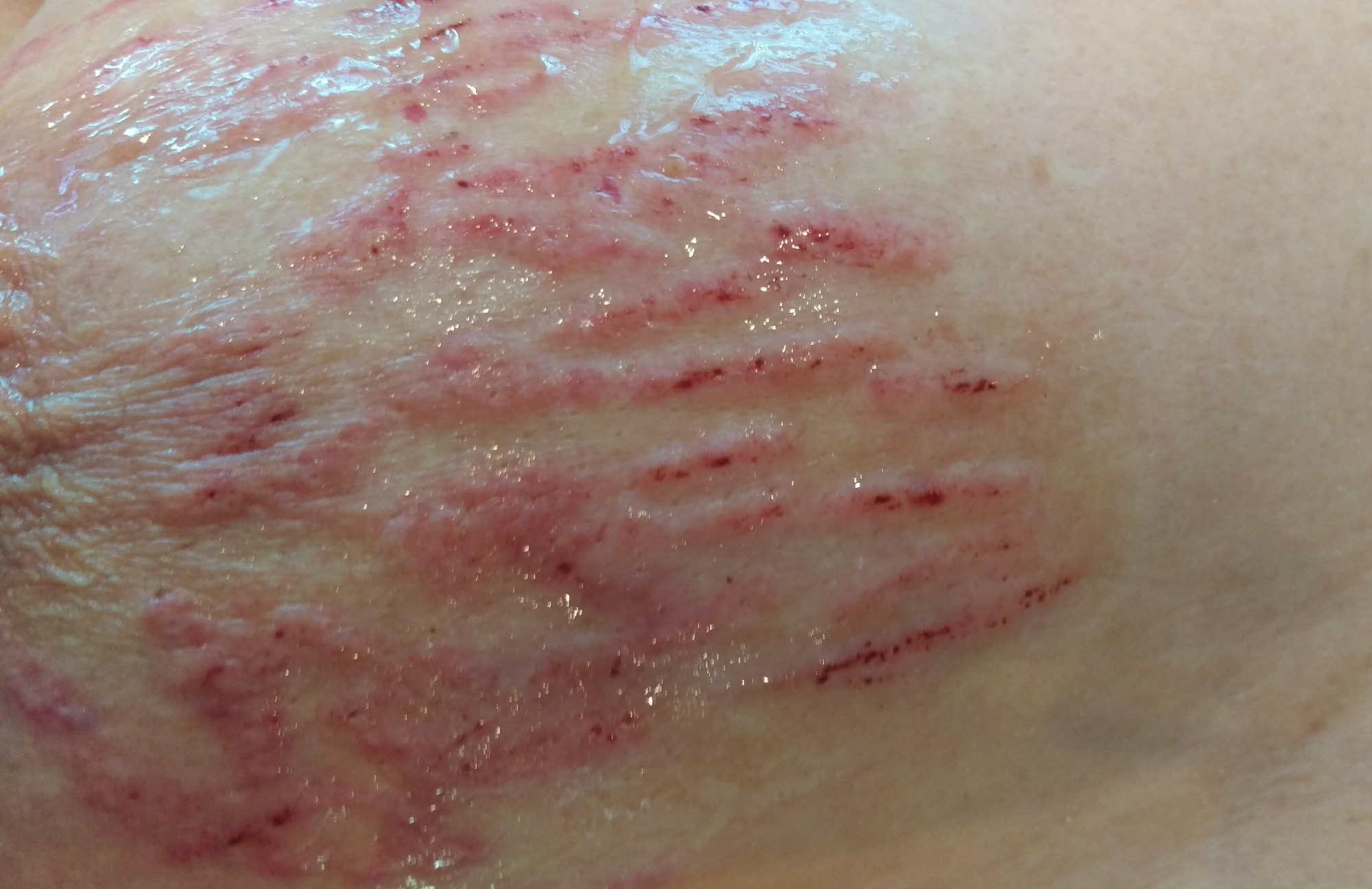 Skin neadling, zabieg zmniejszający blizny i rozstępy