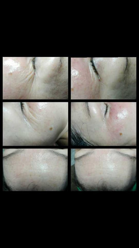 Kompozycja sześciu zbliżeń skóry twarzy przed i po zabiegu, ukazująca redukcję zmarszczek i poprawę wyglądu cery.