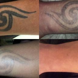 Usuwanie tatuażu laserem pikosekundowym nowej generacji.