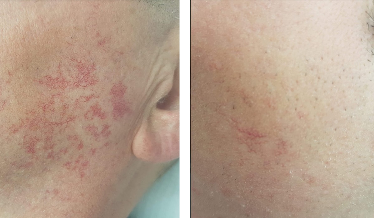 Zamykanie naczynek, pajączków laserem nowej generacji.