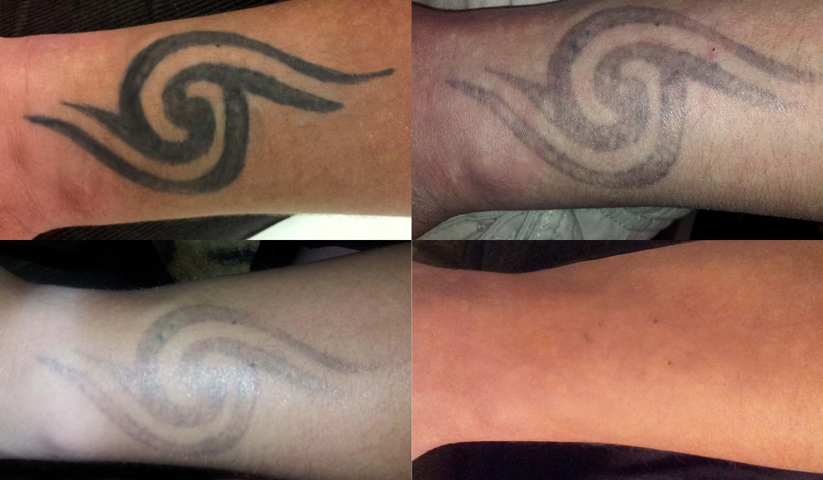 Usuwanie tatuażu laserem pikosekundowym nowej generacji.