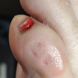 Efekt po usunięciu odcisku!