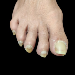 Pielęgnacja zgrubiałych paznokci!