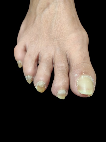 Pielęgnacja zgrubiałych paznokci!