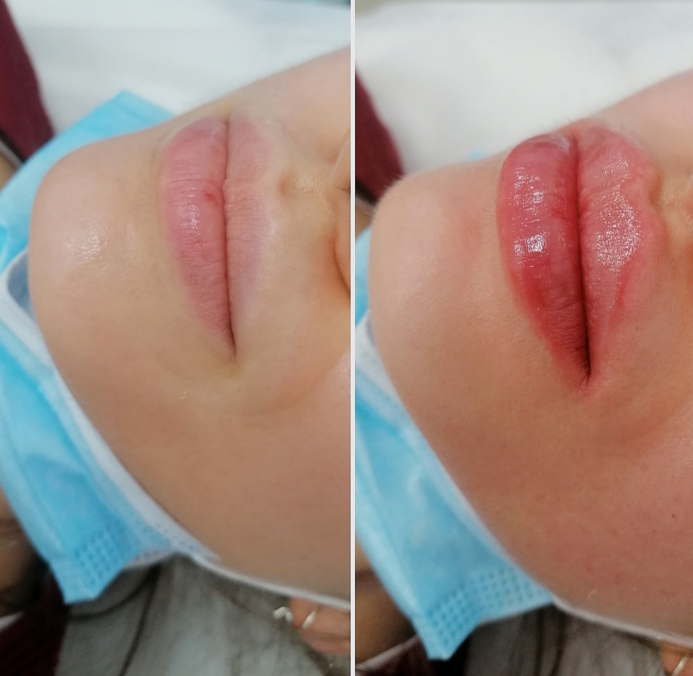 Porównanie ust przed i po zabiegu pigmentacji; po prawej stronie usta bezpośrednio po zabiegu, z widoczną pigmentacją i błyszczącą powierzchnią, po lewej stronie usta przed zabiegiem, w naturalnym...