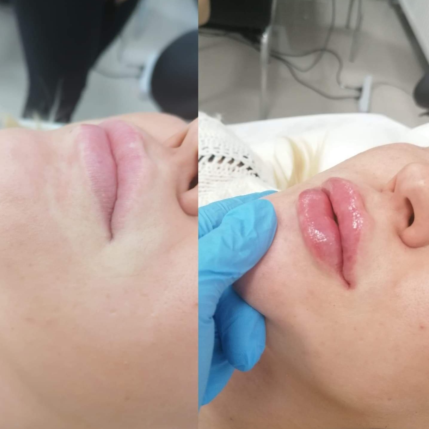 Porównanie ust przed i po zabiegu powiększania, widoczne zaczerwienienie i błyszczący preparat na ustach po zabiegu, dłoń w niebieskiej rękawiczce w kadrze.