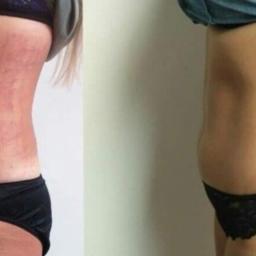 Esthetic beauty salon - Zdjęcie porównawcze sylwetki kobiety przed i po zabiegu, widoczne zaczerwienienia na skórze po lewej stronie.