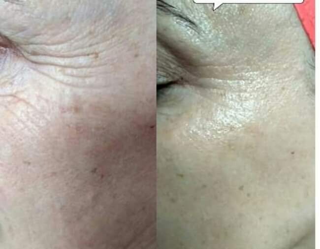 Porównanie skóry twarzy przed i po zabiegu, widoczne zmniejszenie zmarszczek i przebarwień, zbliżenie na obszar pod okiem.