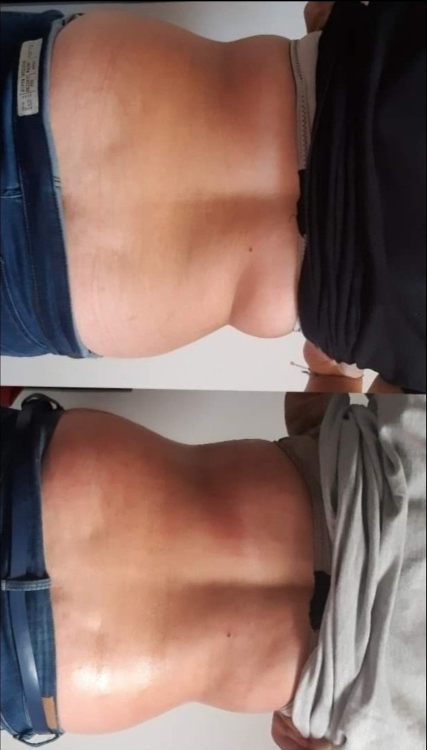 Zdjęcie przedstawia porównanie sylwetki pleców i talii przed i po zabiegu, widoczne zmiany w konturze ciała i redukcja fałd skórnych.