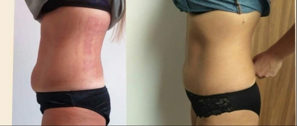 Zdjęcie porównawcze sylwetki kobiety przed i po zabiegu, widoczne zaczerwienienia na skórze po lewej stronie.