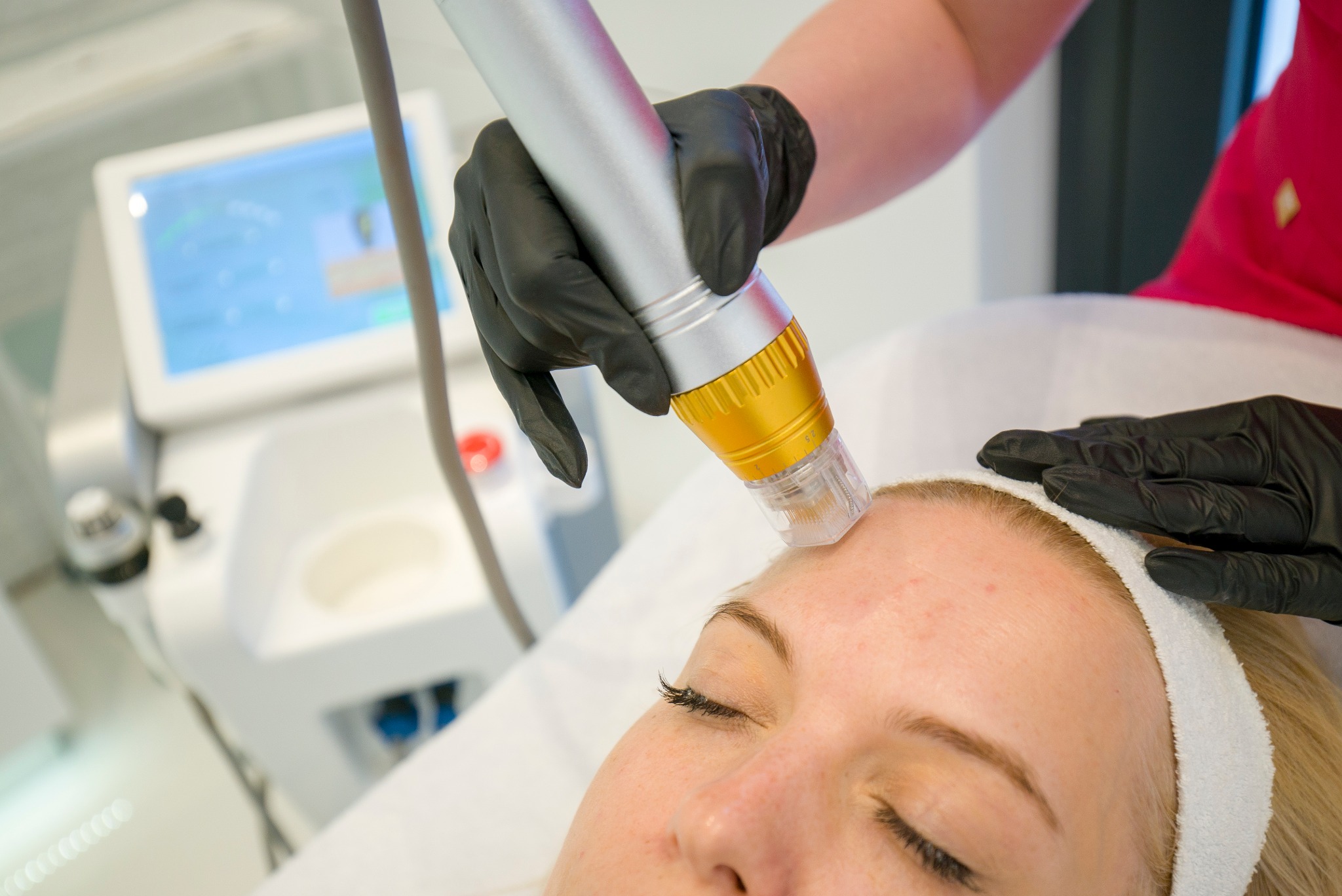 Radiofrekwencja mikroigłowa Kraków