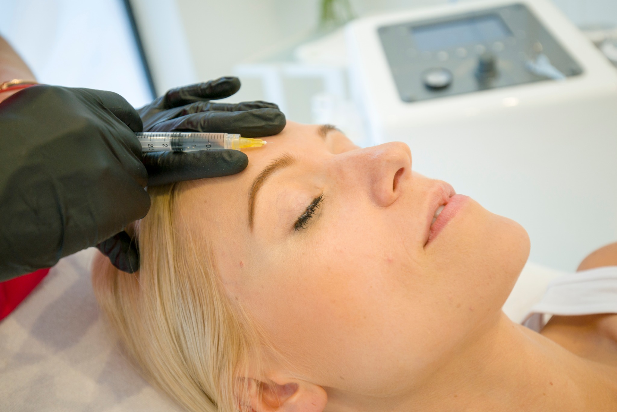 Mezoterapia igłowa, kwasem hialuronowym