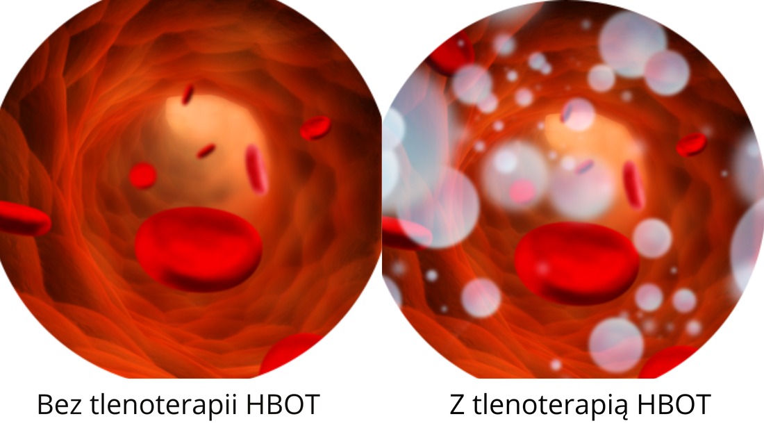 Porównanie wnętrza naczynia krwionośnego przed i po terapii hiperbarycznej HBOT, ukazujące zwiększoną ilość tlenu w postaci białych pęcherzyków.