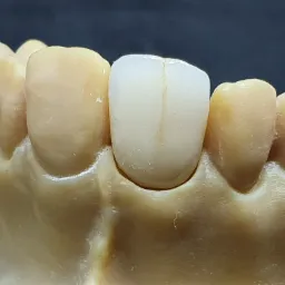 Model gipsowy uzębienia z osadzonym pojedynczym, porcelanowym zębem, charakteryzującym się wyraźną linią pośrodkową, na tle ciemnego tła.