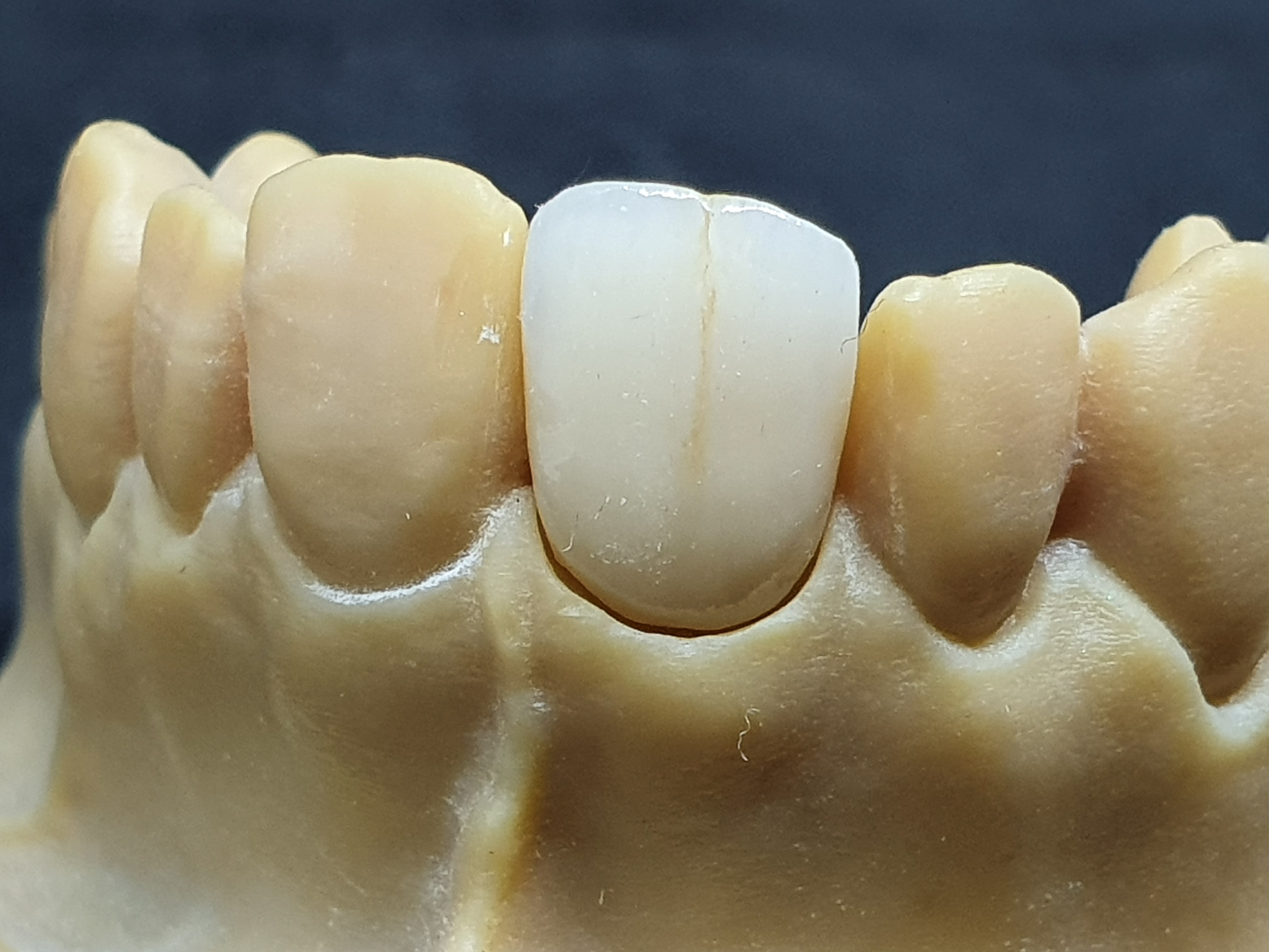 Model gipsowy uzębienia z osadzonym pojedynczym, porcelanowym zębem, charakteryzującym się wyraźną linią pośrodkową, na tle ciemnego tła.