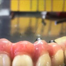 Zbliżenie protezy dentystycznej na implantach, widoczne metalowe łączniki i różowa imitacja dziąseł, w tle rozmyte narzędzia i żółty element wyposażenia.