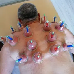 Mężczyzna leżący na brzuchu z bańkami próżniowymi na plecach, widoczne zaczerwienienia skóry pod bańkami, zielone zawory na szczycie baniek.