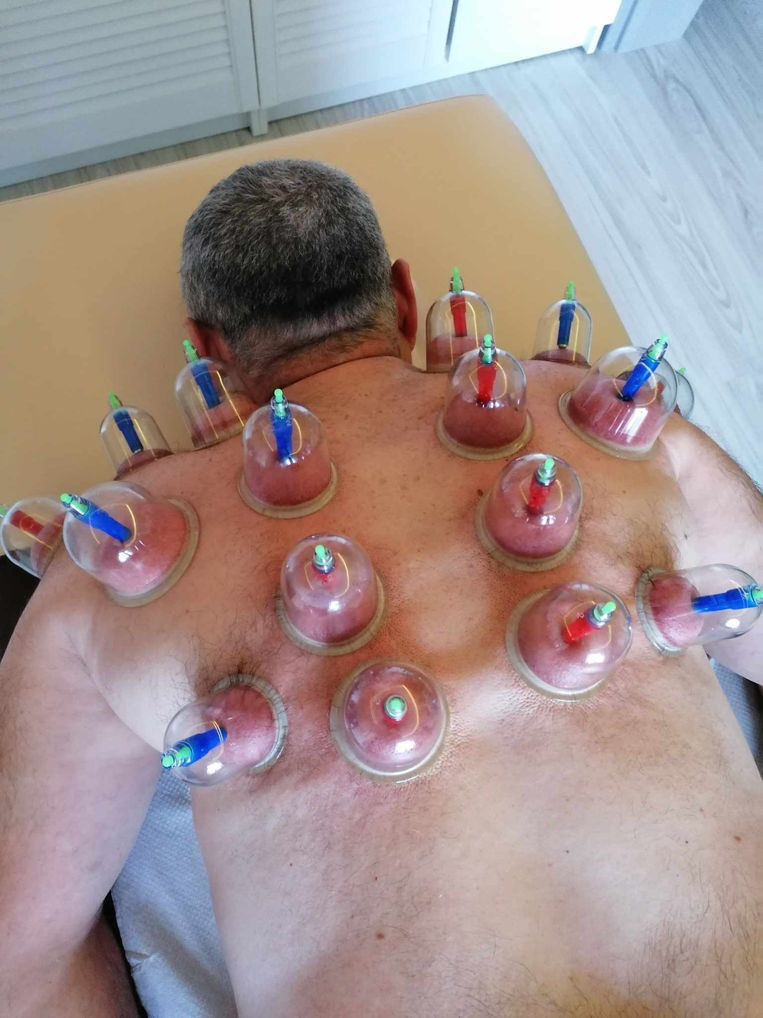 Mężczyzna leżący na brzuchu z bańkami próżniowymi na plecach, widoczne zaczerwienienia skóry pod bańkami, zielone zawory na szczycie baniek.