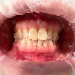 Klinika Stomatologiczna Smilup Warszawa - Przygotowanie do wybielania zębów, osłona Optragate.