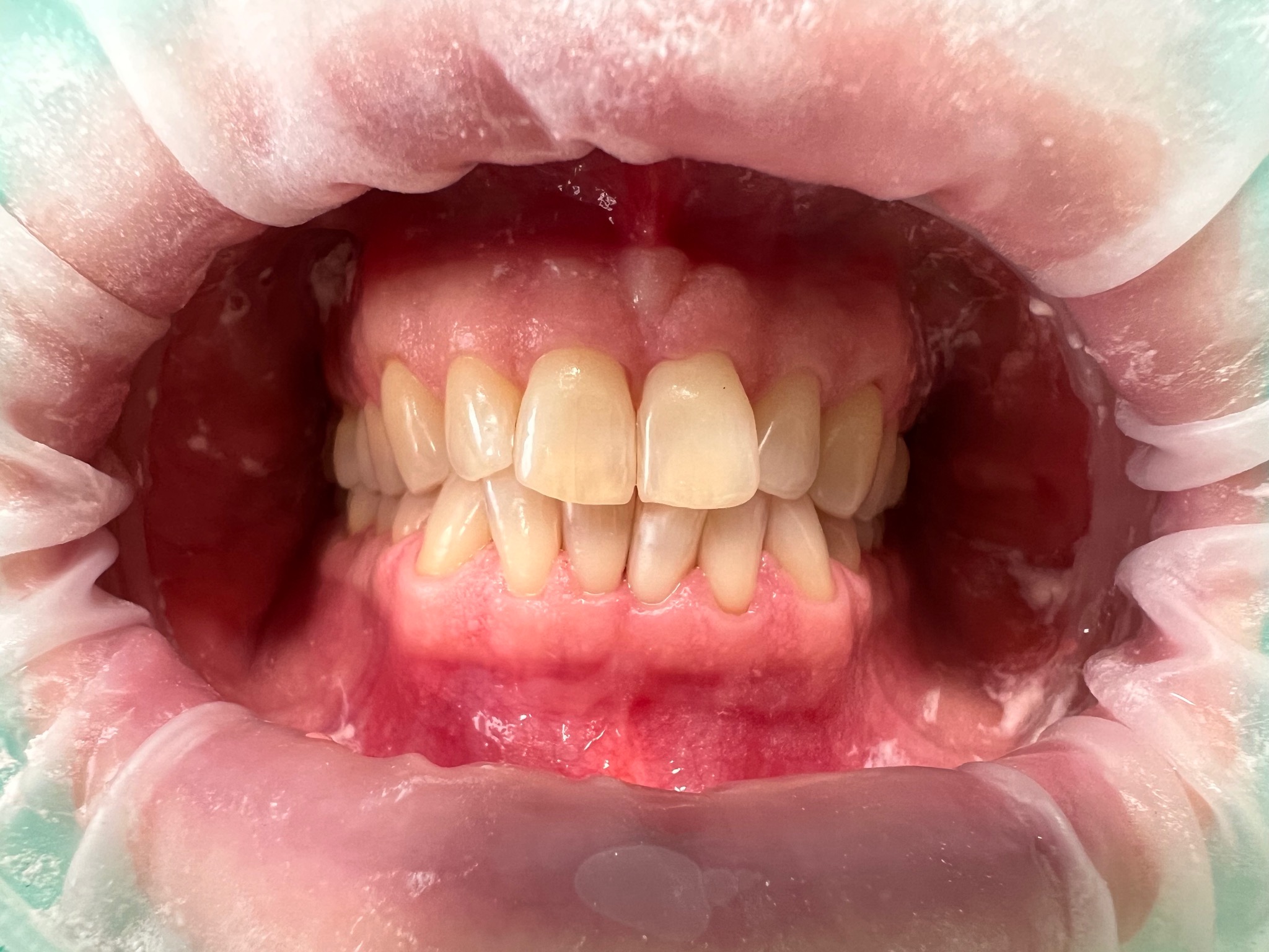 Przygotowanie do wybielania zębów, osłona Optragate.