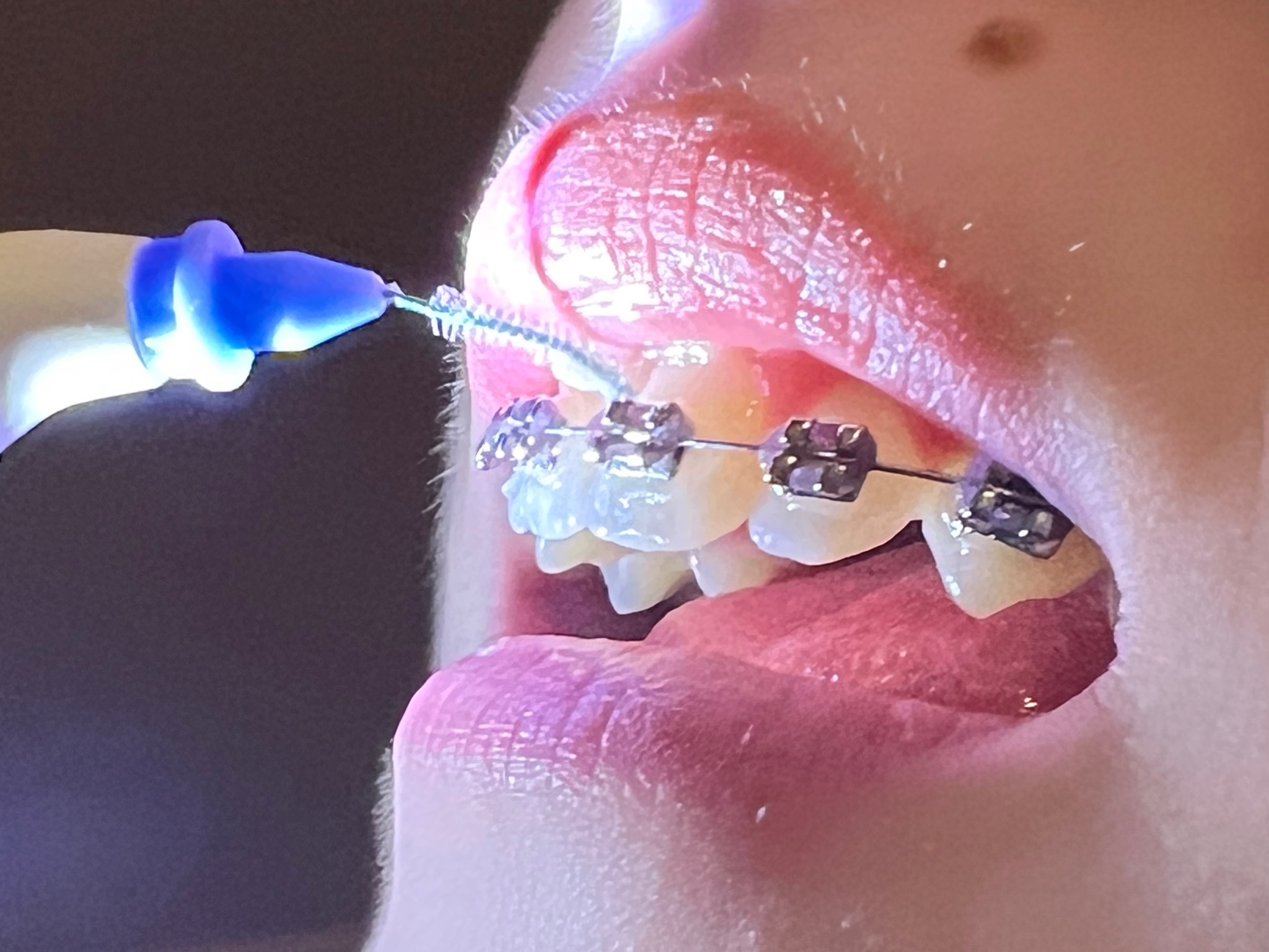 Pacjentka podczas instruktażu higieny po założeniu aparatu ortodontycznego.