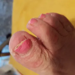 Przybliżenie stopy z pomalowanymi na różowo paznokciami, z widocznymi śladami po obróbce pilnikiem na dużym palcu.