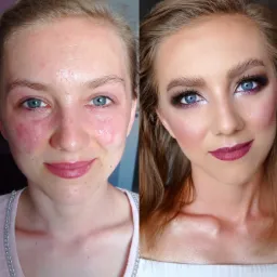 Zdjęcie przedstawia metamorfozę twarzy kobiety: po lewej stronie skóra przed zabiegiem, z widocznymi zaczerwienieniami, po prawej stronie twarz po wykonaniu profesjonalnego upiększenia...