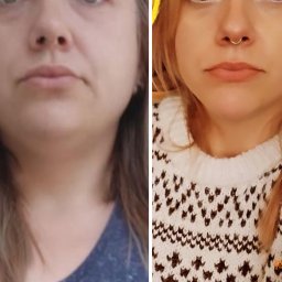 hollywoodbodybuilding - Dwa ujęcia twarzy tej samej kobiety, po lewej przed, po prawej po zabiegu; widoczna poprawa owalu twarzy i redukcja podbródka.