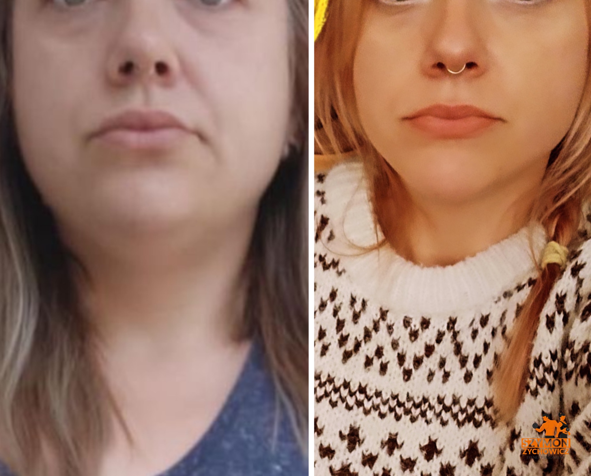 Dwa ujęcia twarzy tej samej kobiety, po lewej przed, po prawej po zabiegu; widoczna poprawa owalu twarzy i redukcja podbródka.