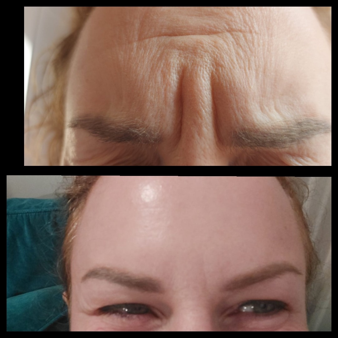 Botox Czoło i Lwia Zmarszczka