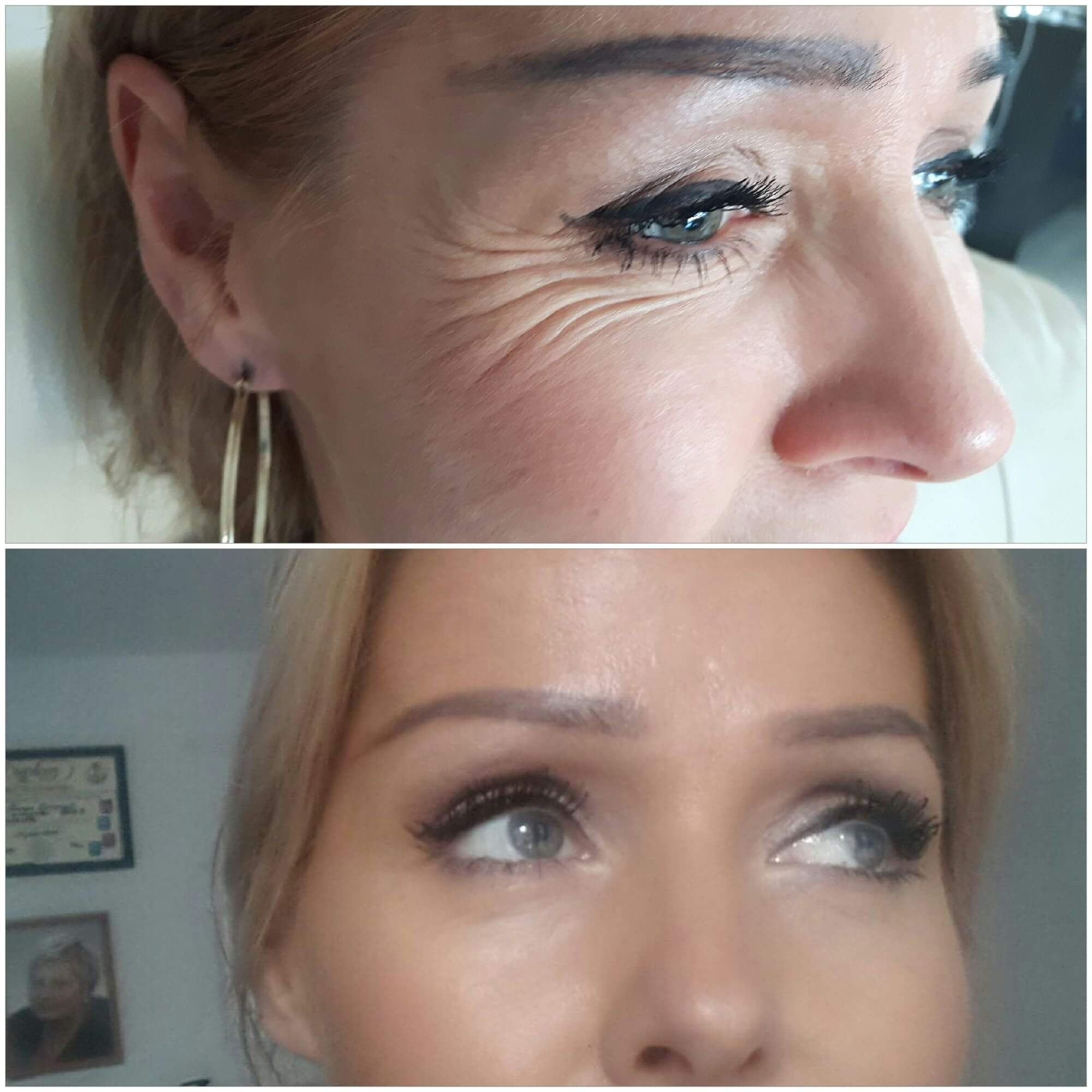 Botox kurze łapki