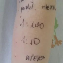 Przedramię pacjenta z zaznaczonymi punktami po wykonanych testach skórnych i odręcznymi notatkami dotyczącymi wyników.