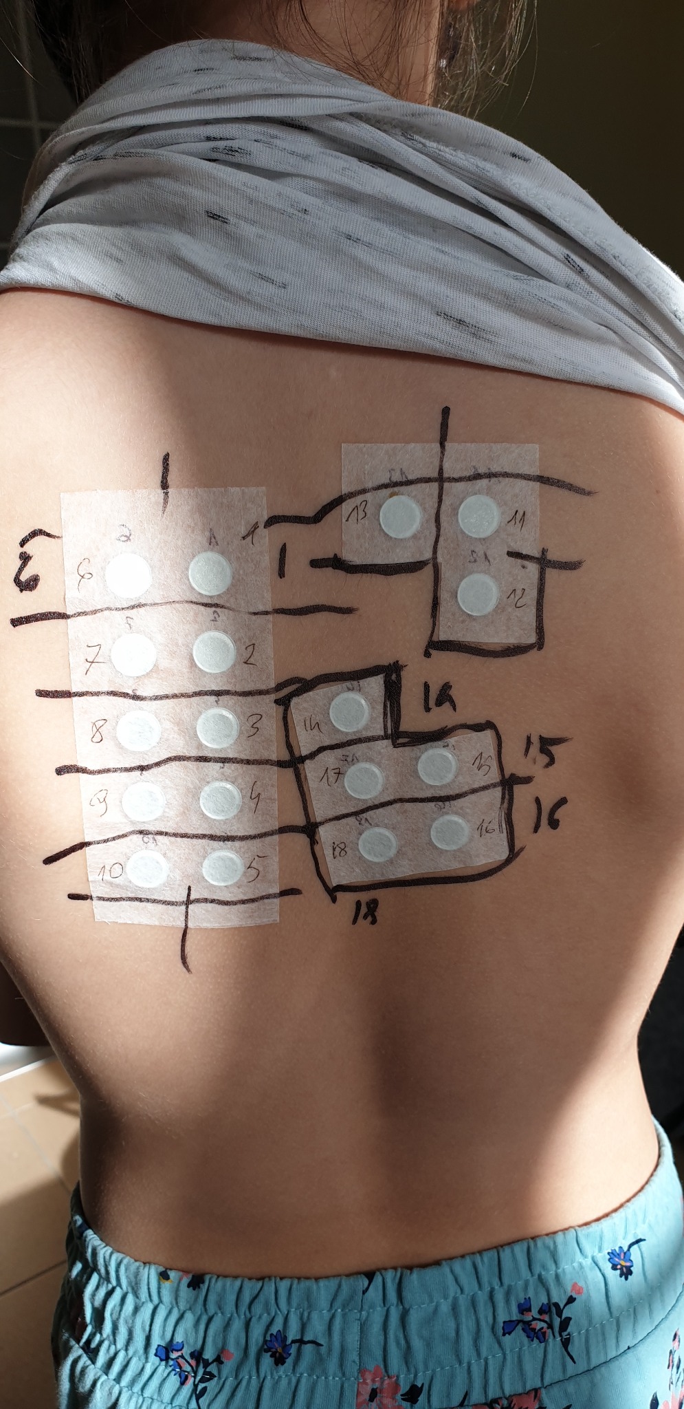 Testy płatkowe alergolog bialystok Grzegorz Siergiejko