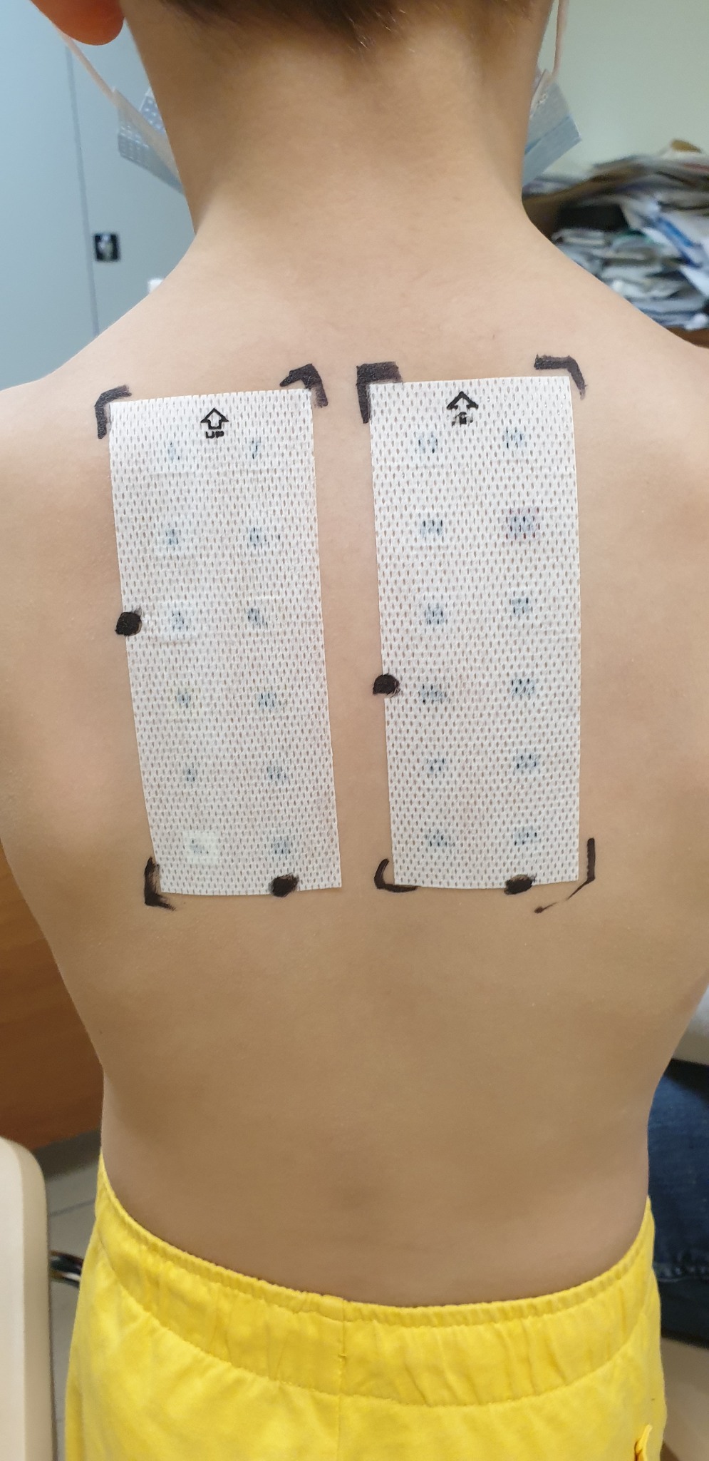 Testy płatkowe na plecach pacjenta z zaznaczonymi polami reakcji, widoczne dwie naklejone płytki testowe z czarnymi obrysami.