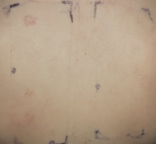 Skóra pacjenta z zaznaczonymi obszarami testów skórnych i widocznymi reakcjami alergicznymi.