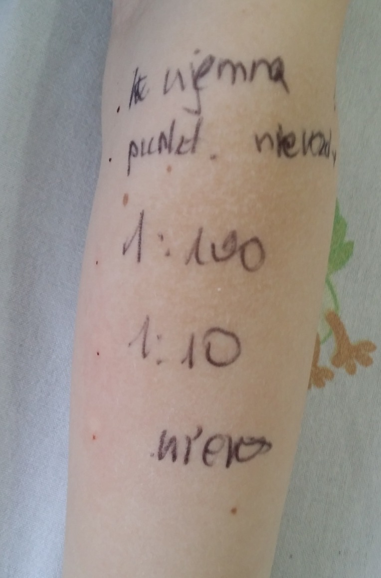 Przedramię pacjenta z zaznaczonymi punktami po wykonanych testach skórnych i odręcznymi notatkami dotyczącymi wyników.