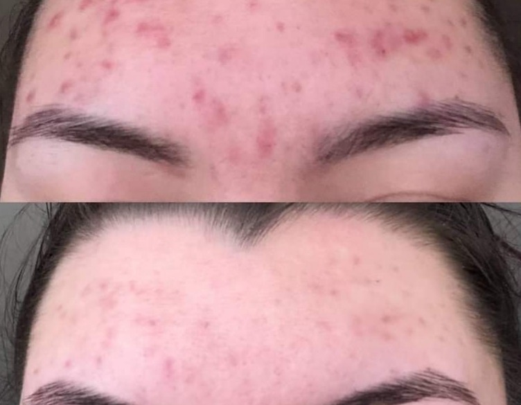 Zbliżenie na czoło kobiety: górna część zdjęcia przedstawia skórę przed zabiegiem z widocznymi zmianami trądzikowymi, dolna część pokazuje skórę po zabiegu, z wyraźną poprawą i redukcją...