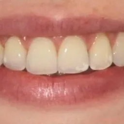 Uśmiech kobiety z widocznymi, lekko przebarwionymi zębami przednimi, ukazujący efekt wybielania lub nałożenia licówek.