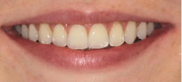 Uśmiech kobiety z widocznymi, lekko przebarwionymi zębami przednimi, ukazujący efekt wybielania lub nałożenia licówek.