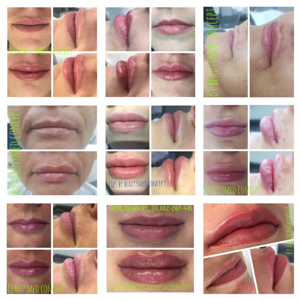 Kolaż zdjęć przedstawiających usta przed i po zabiegu powiększania, z widocznymi efektami wolumetrii i nawilżenia, wykonany przez Beautymed Concept.